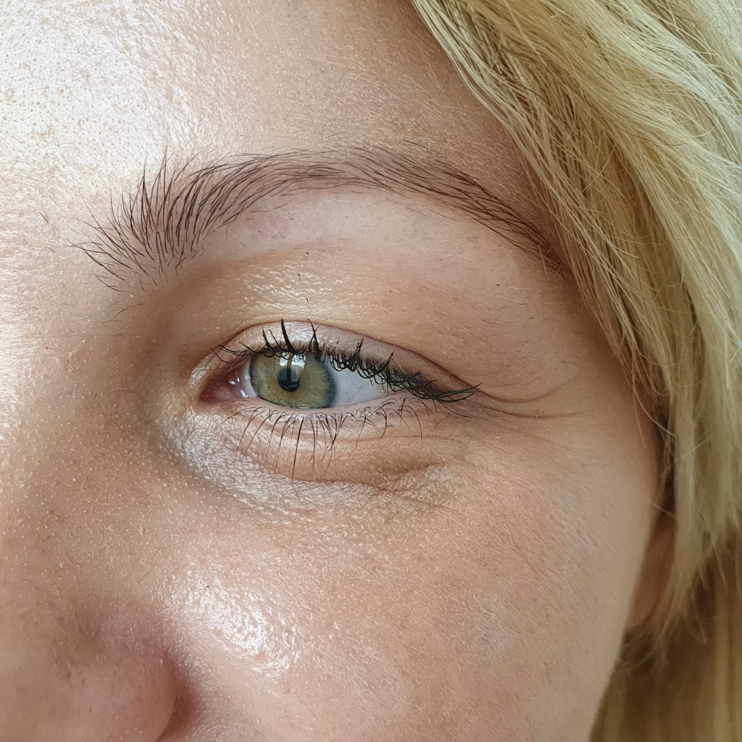 Before using Silkfirm — visible crow's feet and under-eye wrinkles